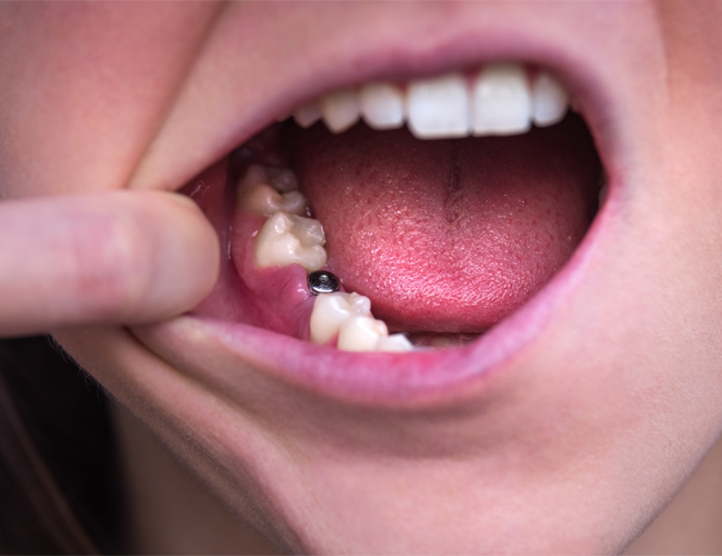 Invisalign treatment at Northdene