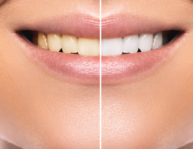 Invisalign treatment at Northdene